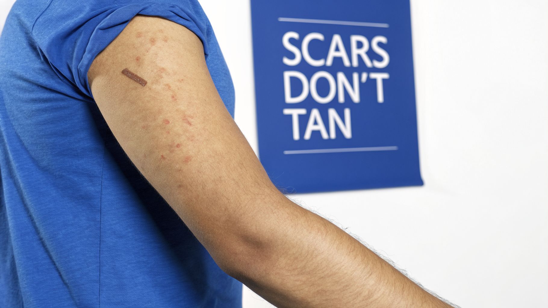 A person's arm with a prominent brown scar and red spots, next to a 'SCARS DON'T TAN' sign.
